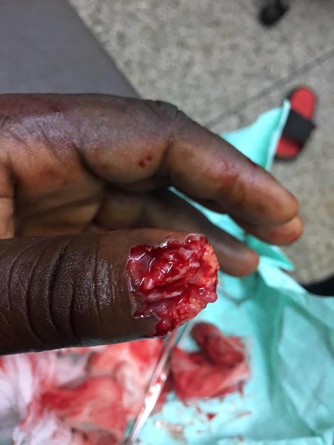 The butchered finger of Mr.Morrison when he was first attacked on November 4, 2018